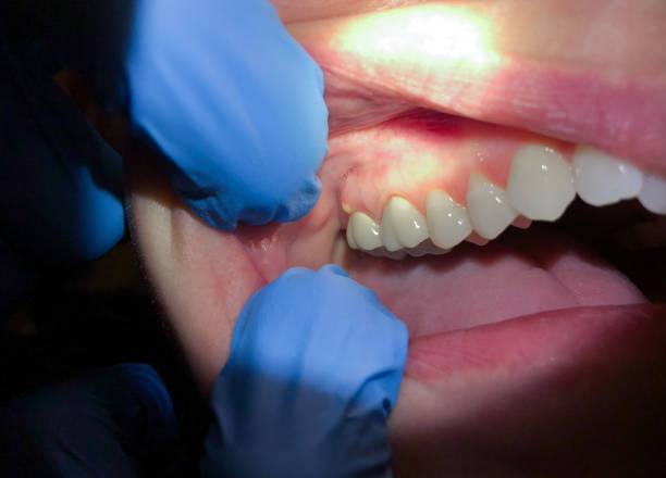 Best Urgent Tooth Repair  in Combe, LA