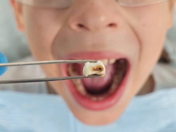 Best Dentist for Tooth Abscess  in Combe, LA